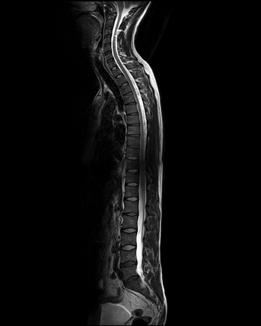 Spine MRI 2022
